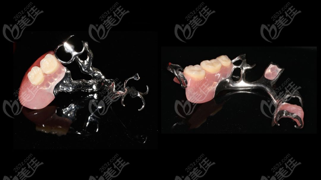 目前,活动义齿支架的种类有这几种:胶托类支架,钴铬支架,bpd支架,维他
