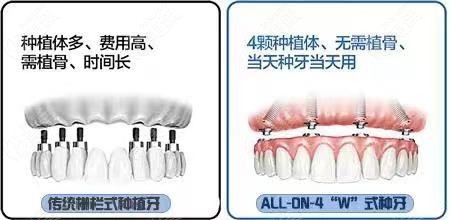 邢台口腔医院种植牙报价表中也有老人做全口种植牙价格呢