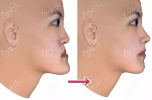 重庆一家医院做的正颌手术脸型变化图对人一辈子的影响挺大的