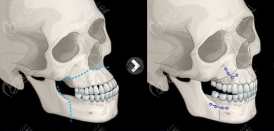 这是一位骨性凸嘴男士的ct图片,术前双颌均前突,突嘴情况是比较厉害