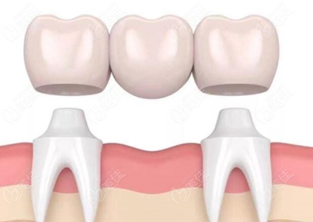 种植3颗牙的牙冠要连在一起好吗想问牙冠独立做还是连体做好呢