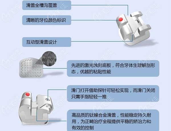文中北京圣玛特互动型托槽和被动型正畸矫正器的介绍均摘自官网