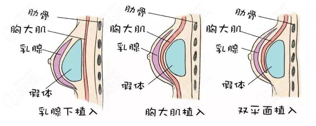 傲诺拉璀璨加脂肪丰胸价格区别在于你做复合式隆胸选的假体型号