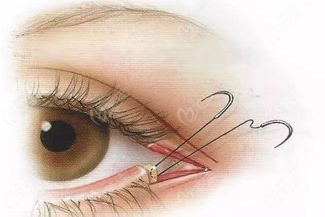 开外眼角手术过程图图片