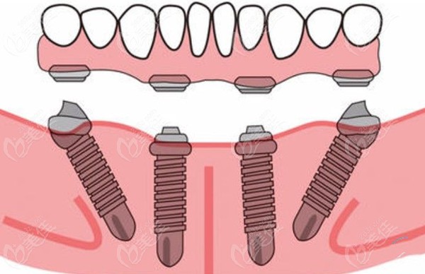 半全口种植牙按技术可分为:半固定种植覆盖义齿,常规点种,all-on-4