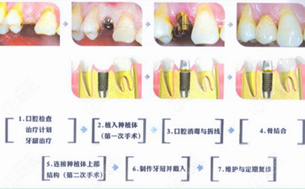 种植牙的流程图