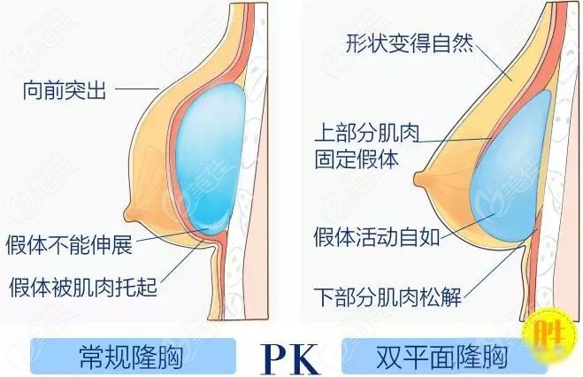 有人说双平面隆胸术后假体会下滑掉下来跑位是真的吗