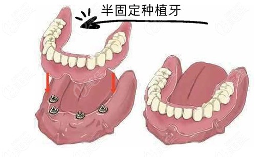 杆卡和locator哪个好杆卡和locator种植覆盖义齿价格差不多但各有优