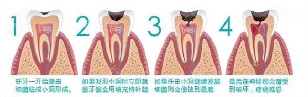 牙齿龋坏过程