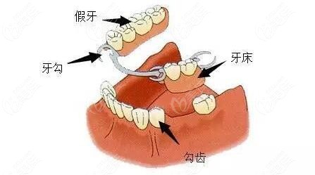 修复活动假牙
