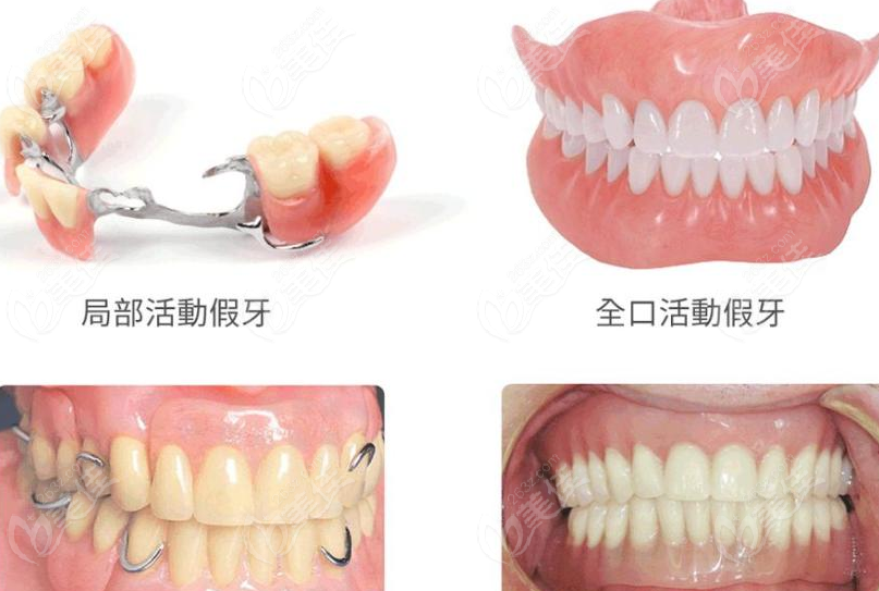 缺牙修复方法
