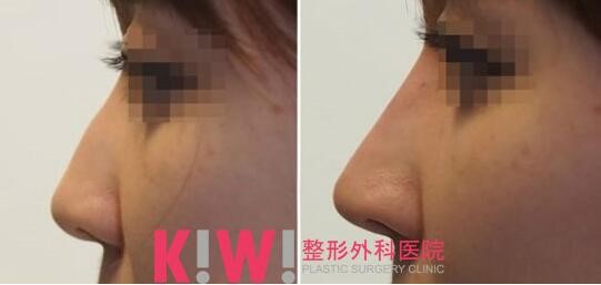 玻尿酸隆鼻案例