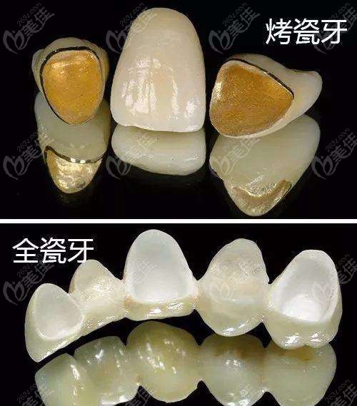 烤瓷牙和全瓷牙外观