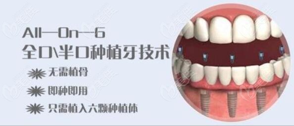 allon6全口种植牙