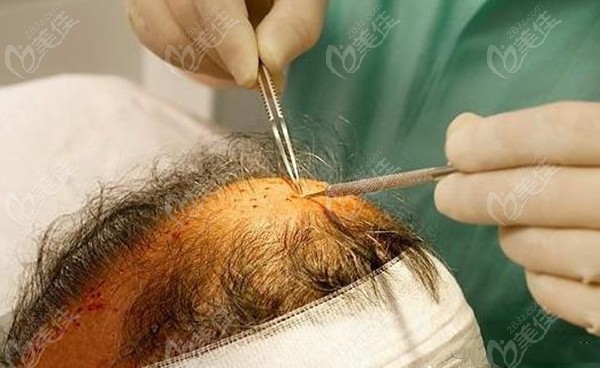 国内常用的毛发移植技术