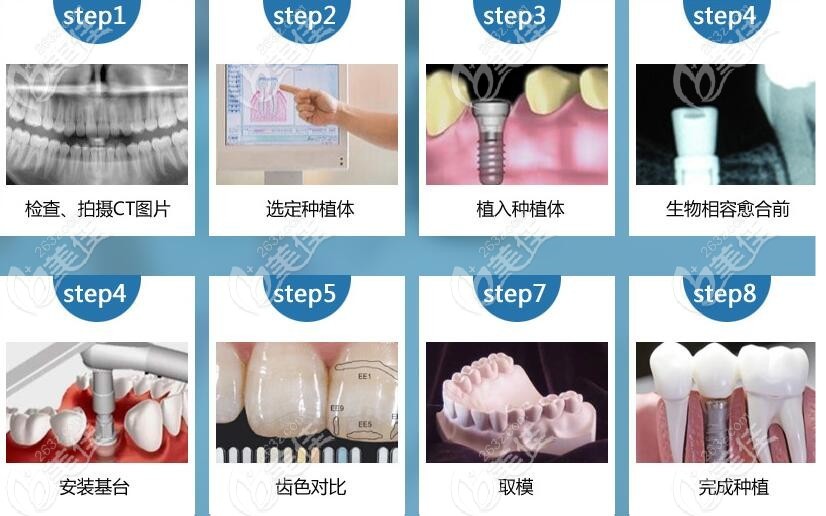广州广大口腔做种植牙的流程
