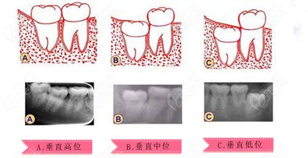 垂直阻生智齿分为3种类型