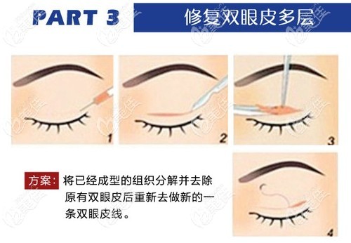 武汉美基元多层双眼皮修复方法