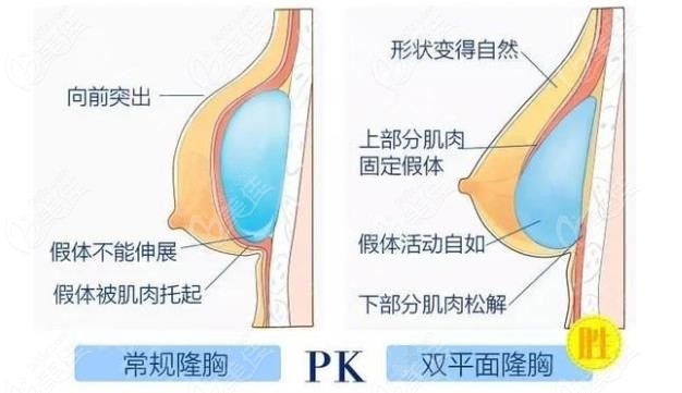宿州京美2C双平面隆胸与传统隆胸优势对比