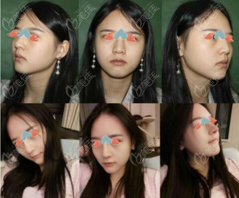 娄底希美蒋松林院长做的鼻子实例