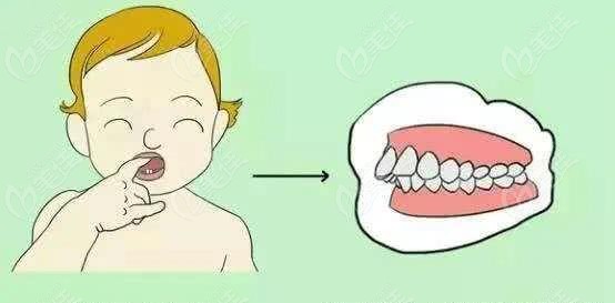 乳牙期矫正反合问题