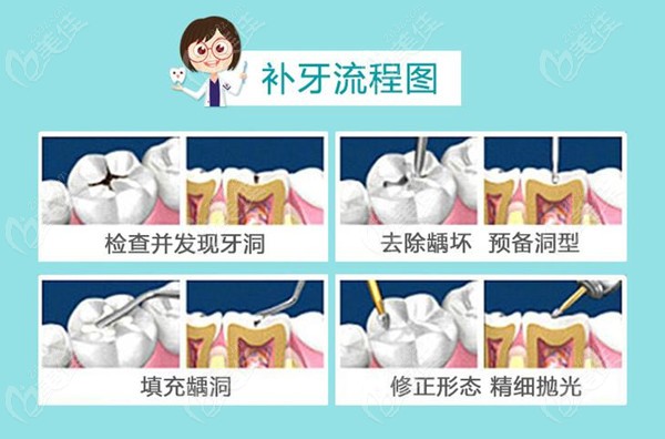 龋齿补牙流程图
