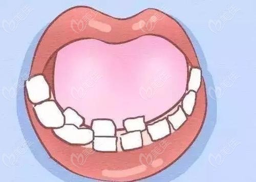 替牙期阶段的牙齿问题