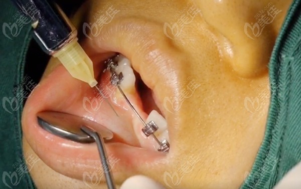分享我牙齿矫正过程中做种植牙的视频，啪啪打脸说正畸完不能种植的