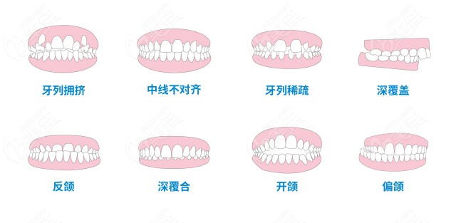 牙齿畸形的症状有哪些？