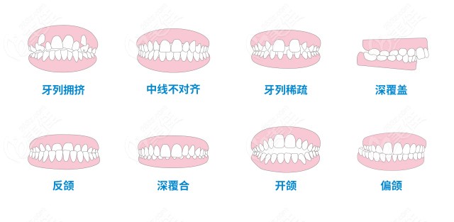 牙齿畸形的症状有哪些？