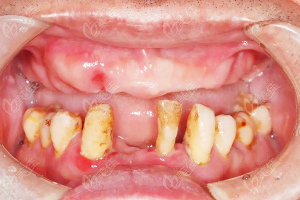 牙周病患者的种植前口内照