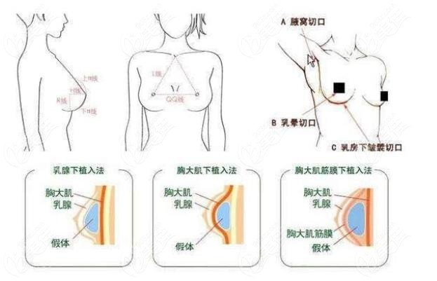 宿州京美医院杜晓扬医生根据顾客情况定制丰胸方案