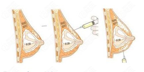 哈尔滨双燕整形自体脂肪隆胸手术过程