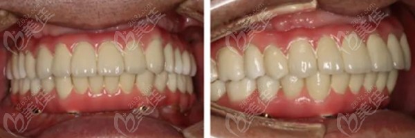 记录allon6种植牙技术实现全口即刻种植即刻修复，重度牙周炎患者的福音