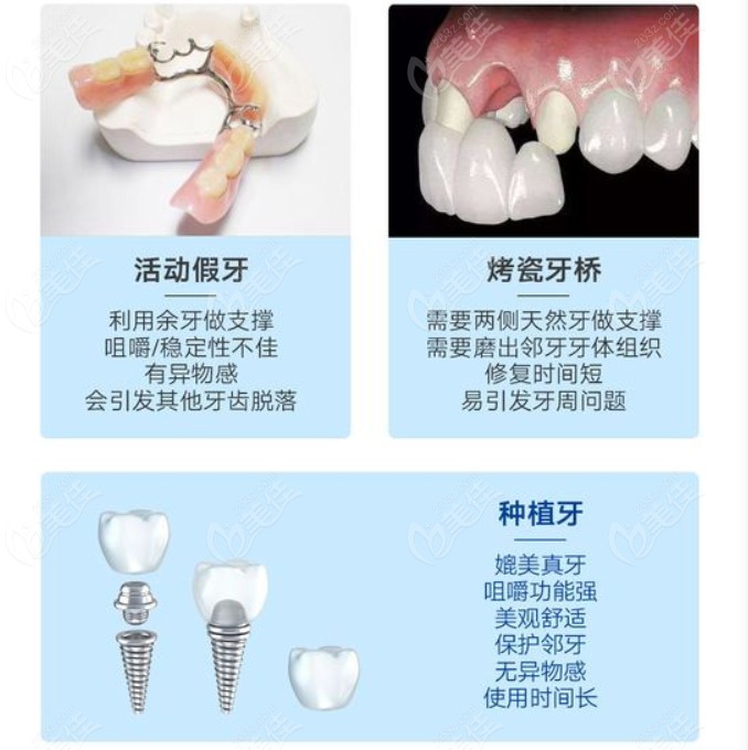 深圳美奥口腔种植牙对比活动假牙烤瓷牙桥优点