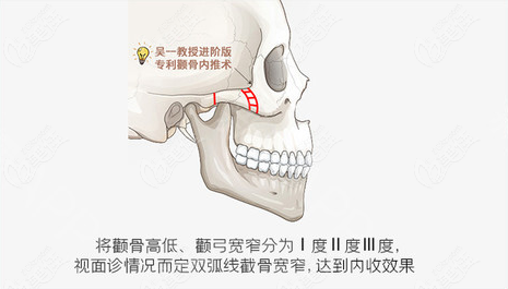 双弧线颧骨颧弓降低术