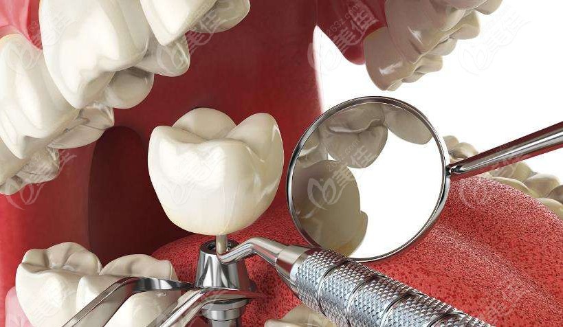 丽江牙科医院种植一颗牙多少钱