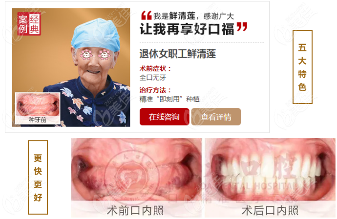 广州广大口腔种植牙效果好不好