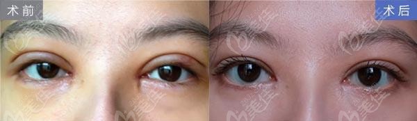 尹度龙双眼皮修复术前术后效果对比图