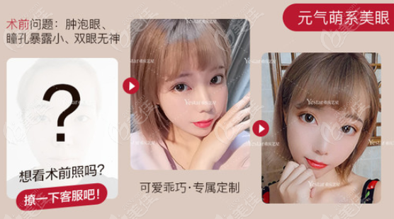 罗宁川医生做的肿炮眼眼综合效果