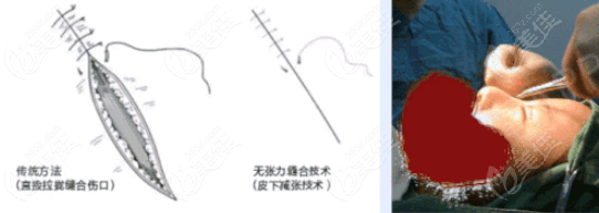 眼部四层无张力缝合技术