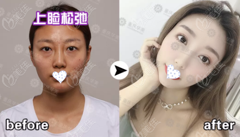 李富强提肌手术+祛眼袋效果图