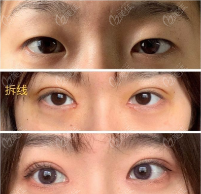 重庆军科王科医生全切双眼皮效果图