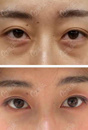 郑荃院长纳米无痕祛眼袋效果图