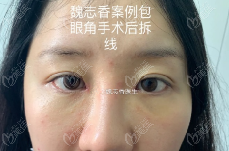 北京魏志香医生的BER包内眼角手术技术真是挺过关的,我朋友由衷的说!