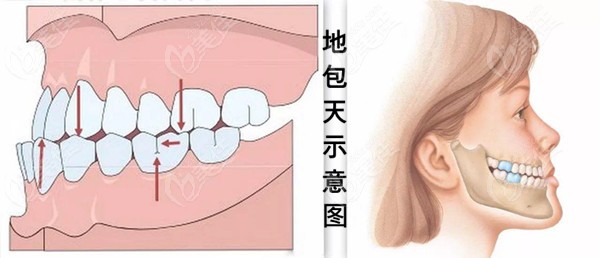 对齿和地包天的区别图片