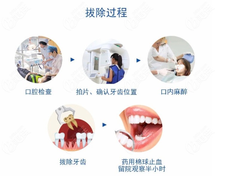 合肥美奥口腔拔牙流程