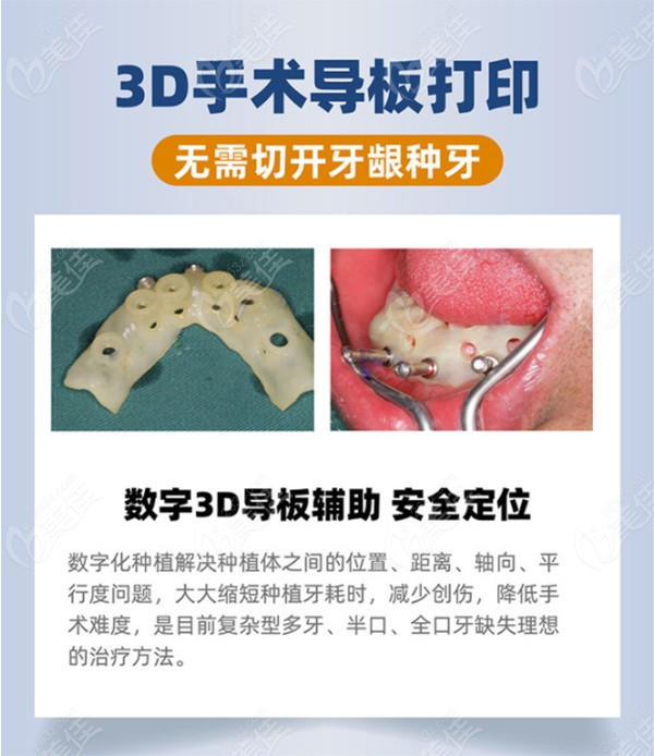 3D数字导板技术