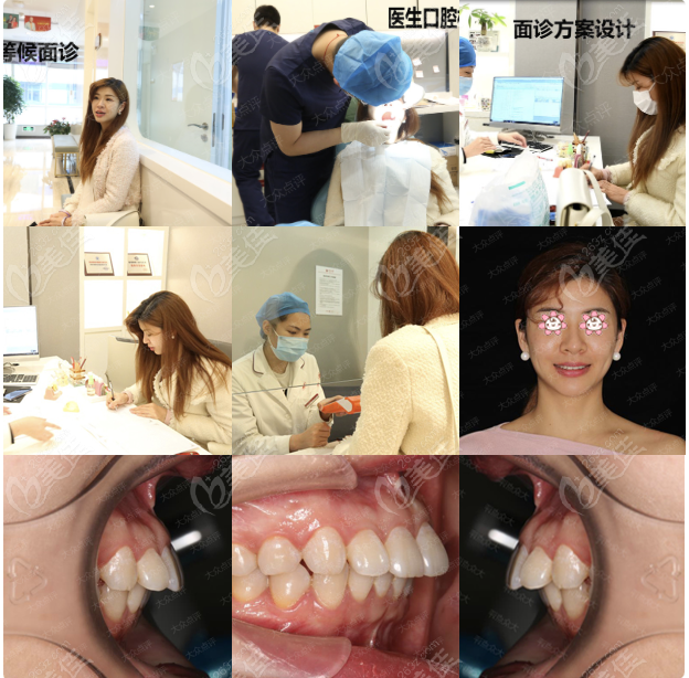 在广州广大口腔做牙齿矫正真实经历分享