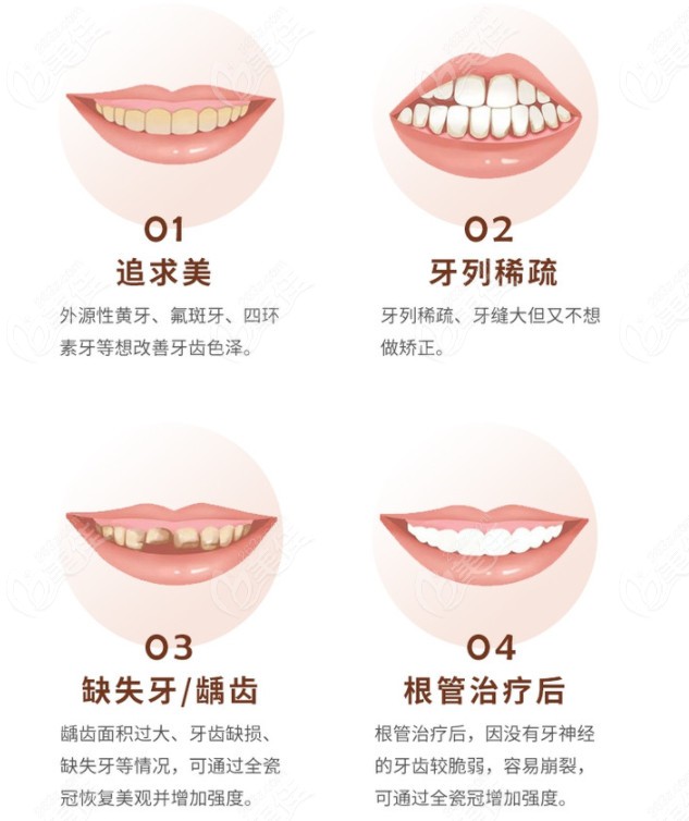 看了蘇州全瓷牙價格表發現德國威蘭德全瓷牙價格也還好